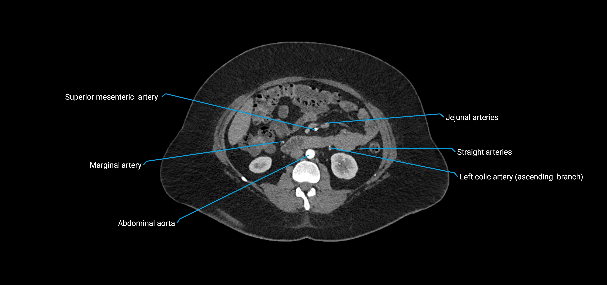 CTA abdomen axial cross sectional anatomy labelled image_90 (2).webp
